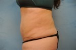 Tummy Tuck (Abdominoplasty)