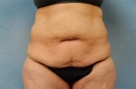 Tummy Tuck (Abdominoplasty)