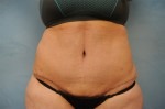 Tummy Tuck (Abdominoplasty)