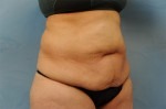 Tummy Tuck (Abdominoplasty)