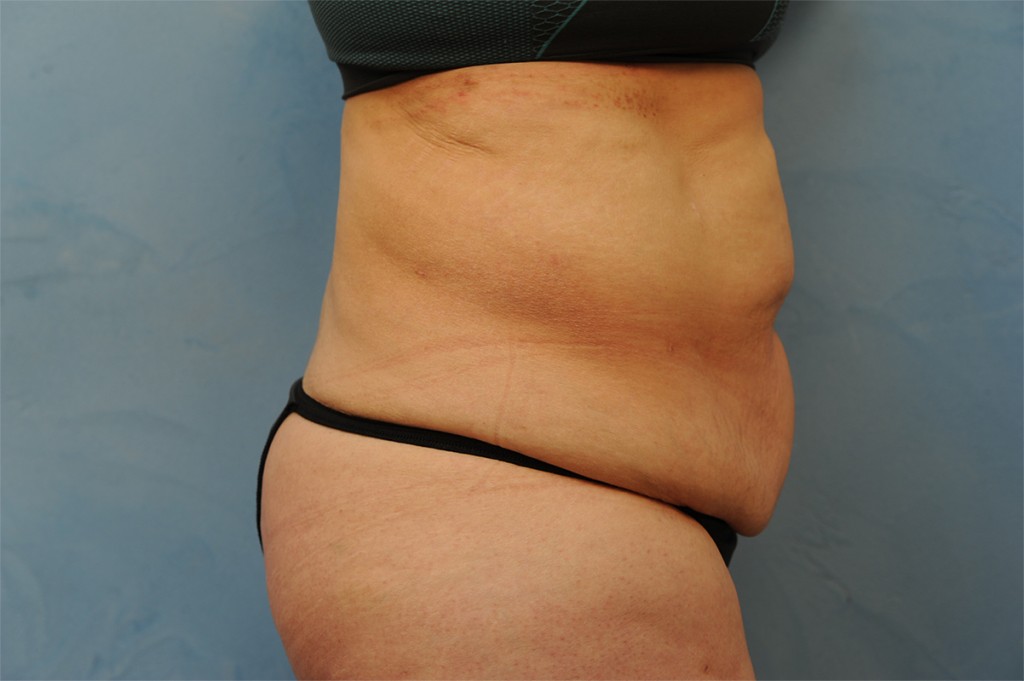 Tummy Tuck (Abdominoplasty)