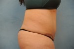 Tummy Tuck (Abdominoplasty)