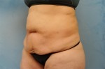 Tummy Tuck (Abdominoplasty)