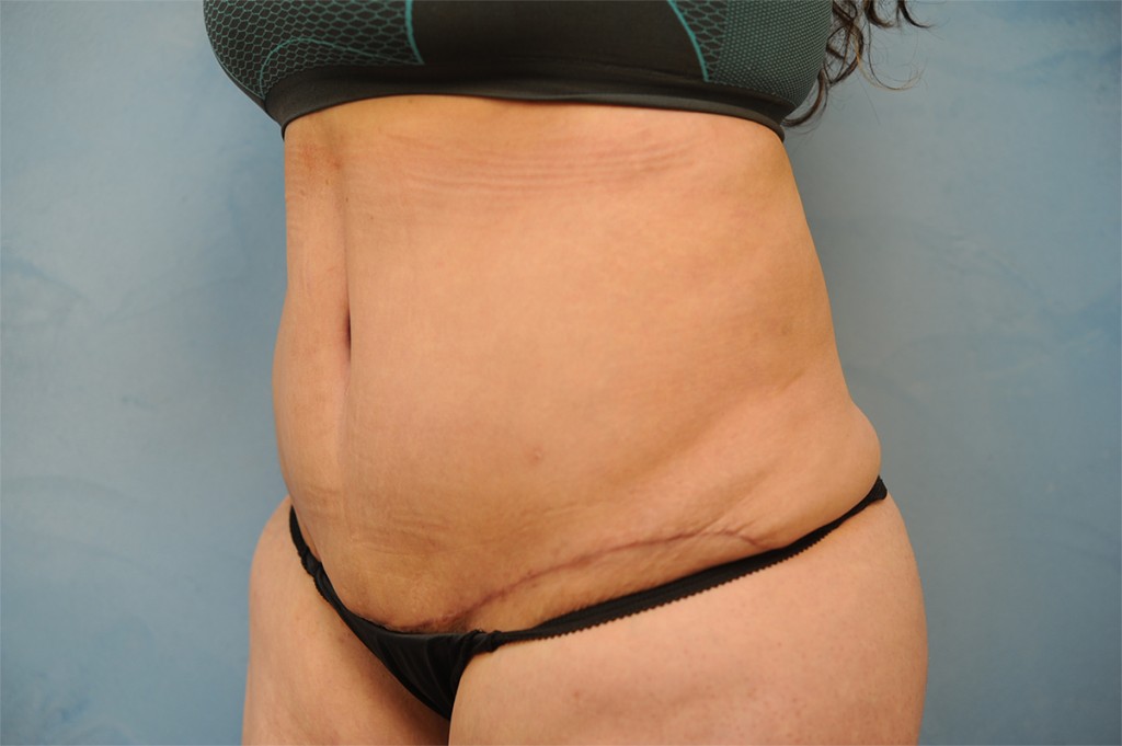 Tummy Tuck (Abdominoplasty)