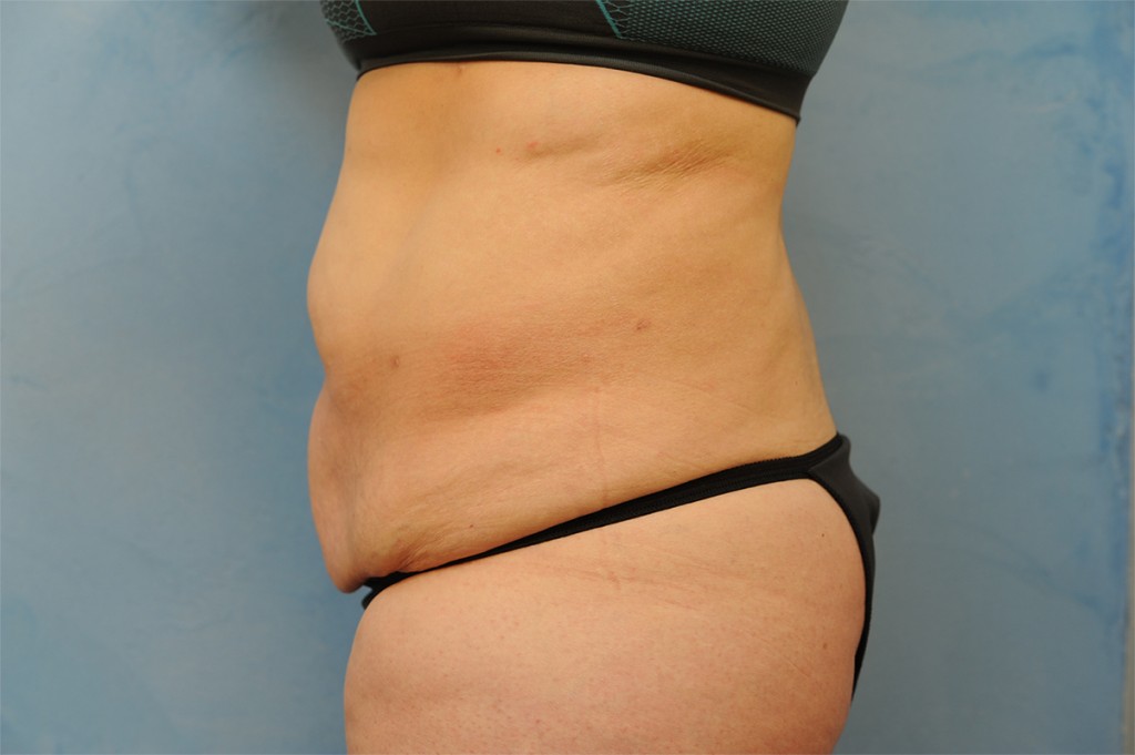 Tummy Tuck (Abdominoplasty)