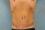 Tummy Tuck (Abdominoplasty)