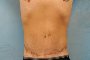 Tummy Tuck (Abdominoplasty)