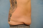 Tummy Tuck (Abdominoplasty)