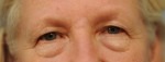 Upper Eye Lift (Blepharoplasty) Photos