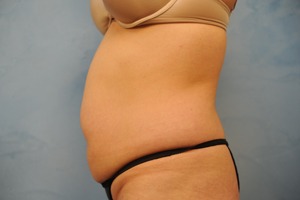 Tummy Tuck (Abdominoplasty)