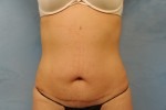 Tummy Tuck (Abdominoplasty)