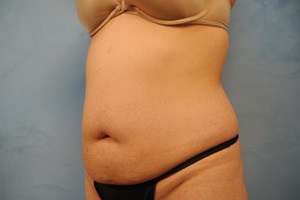 Tummy Tuck (Abdominoplasty)