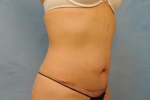 Tummy Tuck (Abdominoplasty)