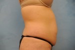 Tummy Tuck (Abdominoplasty)