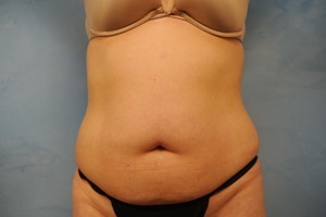 Tummy Tuck (Abdominoplasty)