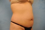 Tummy Tuck (Abdominoplasty)