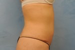 Tummy Tuck (Abdominoplasty)