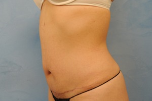 Tummy Tuck (Abdominoplasty)