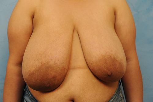Breast Reduction (Reduction Mammoplasty)