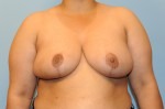 Breast Reduction (Reduction Mammoplasty)