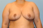 Breast Reduction ( Reduction Mammoplasty)