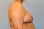 Breast Reduction (Reduction Mammoplasty)