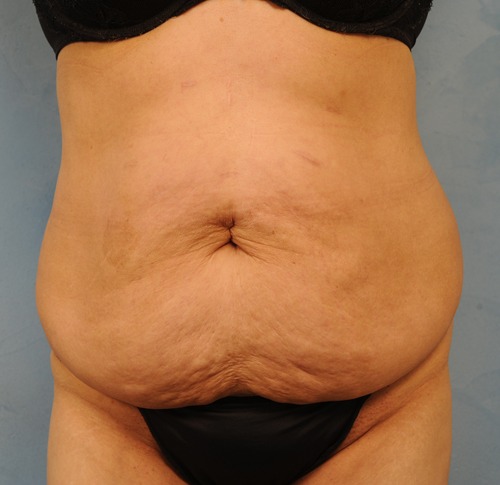 Tummy Tuck (Abdominoplasty)