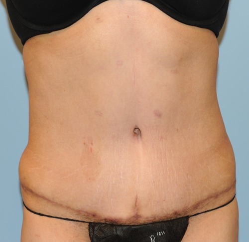 Tummy Tuck (Abdominoplasty)