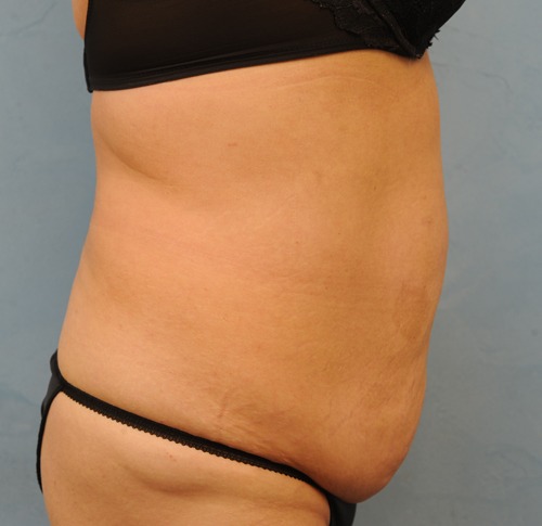 Tummy Tuck (Abdominoplasty)