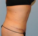 Tummy Tuck (Abdominoplasty)