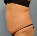 Tummy Tuck (Abdominoplasty)