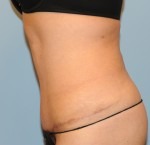 Tummy Tuck (Abdominoplasty)