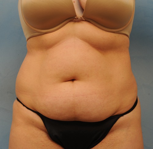 Tummy Tuck (Abdominoplasty)