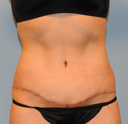 Tummy Tuck (Abdominoplasty)