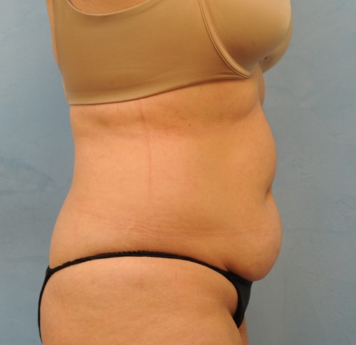 Tummy Tuck (Abdominoplasty)