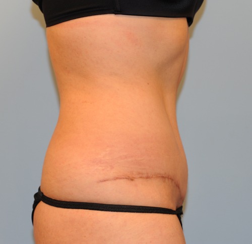 Tummy Tuck (Abdominoplasty)