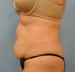 Tummy Tuck (Abdominoplasty)