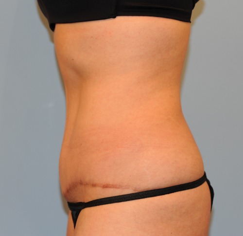 Tummy Tuck (Abdominoplasty)