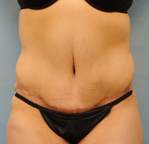 Tummy Tuck (Abdominoplasty)