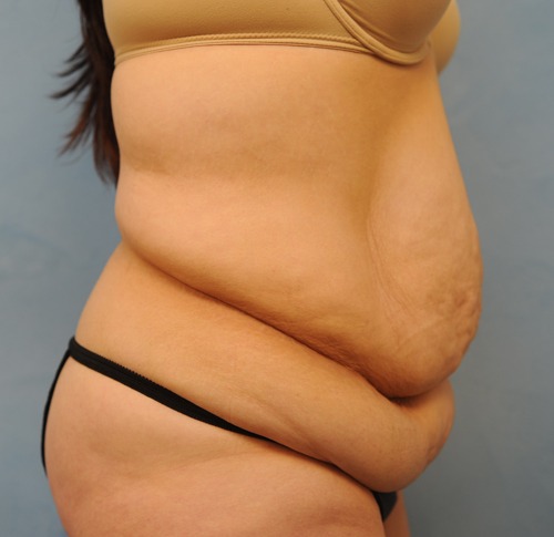 Tummy Tuck (Abdominoplasty)