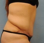 Tummy Tuck (Abdominoplasty)