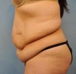 Tummy Tuck (Abdominoplasty)