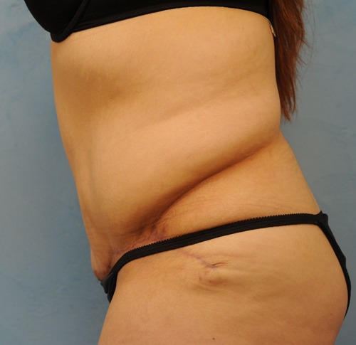 Tummy Tuck (Abdominoplasty)