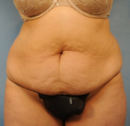 Tummy Tuck (Abdominoplasty)