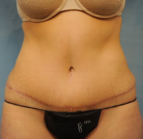 Tummy Tuck (Abdominoplasty)