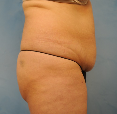 Tummy Tuck (Abdominoplasty)