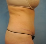 Tummy Tuck (Abdominoplasty)