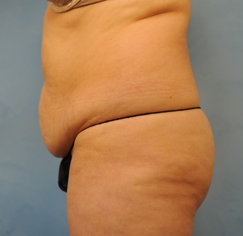 Tummy Tuck (Abdominoplasty)