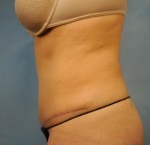Tummy Tuck (Abdominoplasty)