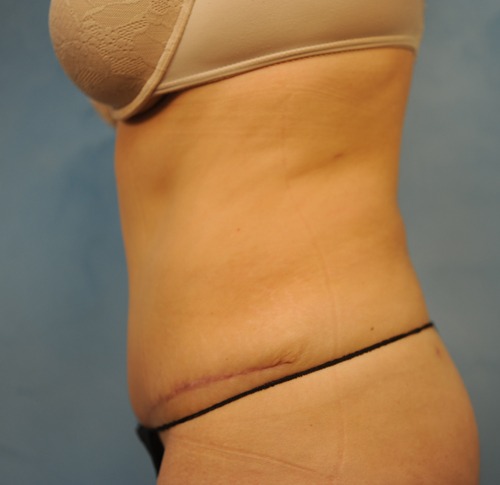 Tummy Tuck (Abdominoplasty)